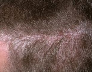 enfermedad de la psoriasis del cuero cabelludo y el cuero cabelludo, foto de la etapa inicial