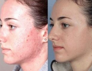 foto de la piel facial después del tratamiento de la psoriasis