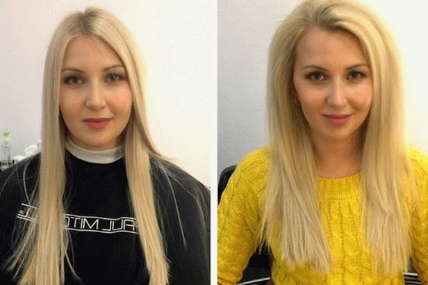 aumento del volumen basal