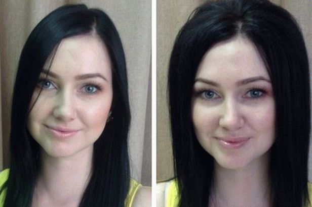 aumento del volumen basal